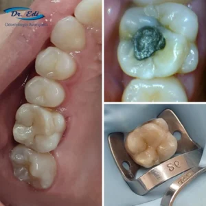 Resultados de dentística em campinas - imagem 10