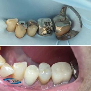 Resultados de dentística em campinas - imagem 11