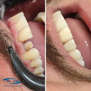 Resultados de dentística em campinas - imagem 12