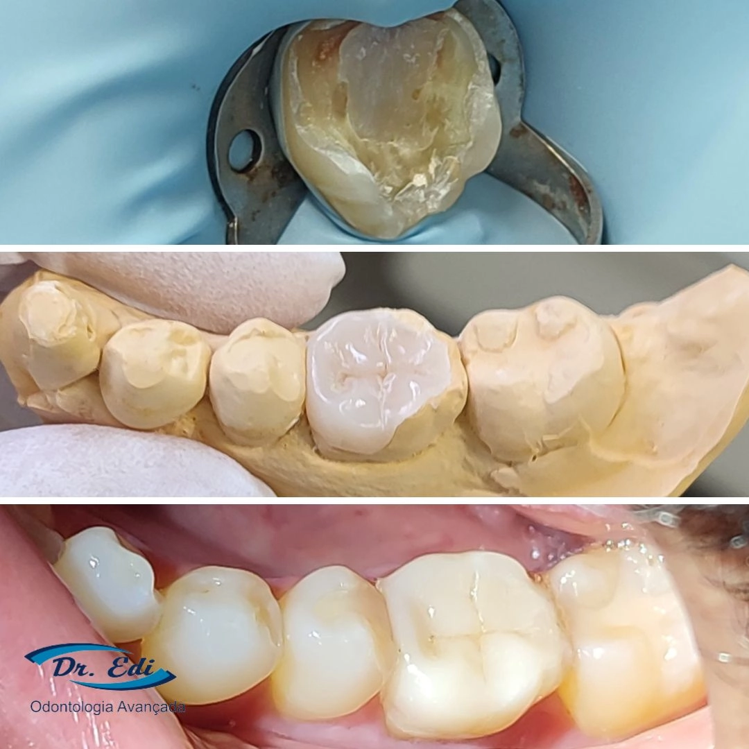 Resultados de dentística em campinas - imagem 14