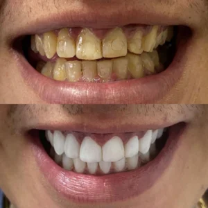 Resultados de facetas em campinas - imagem 14