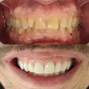 Resultados de facetas em campinas - imagem 15