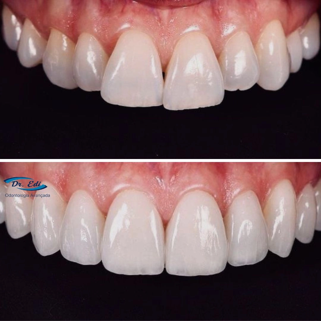 Resultados de dentística em campinas - imagem 18
