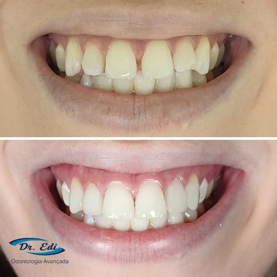 Resultados de dentística em campinas - imagem 20