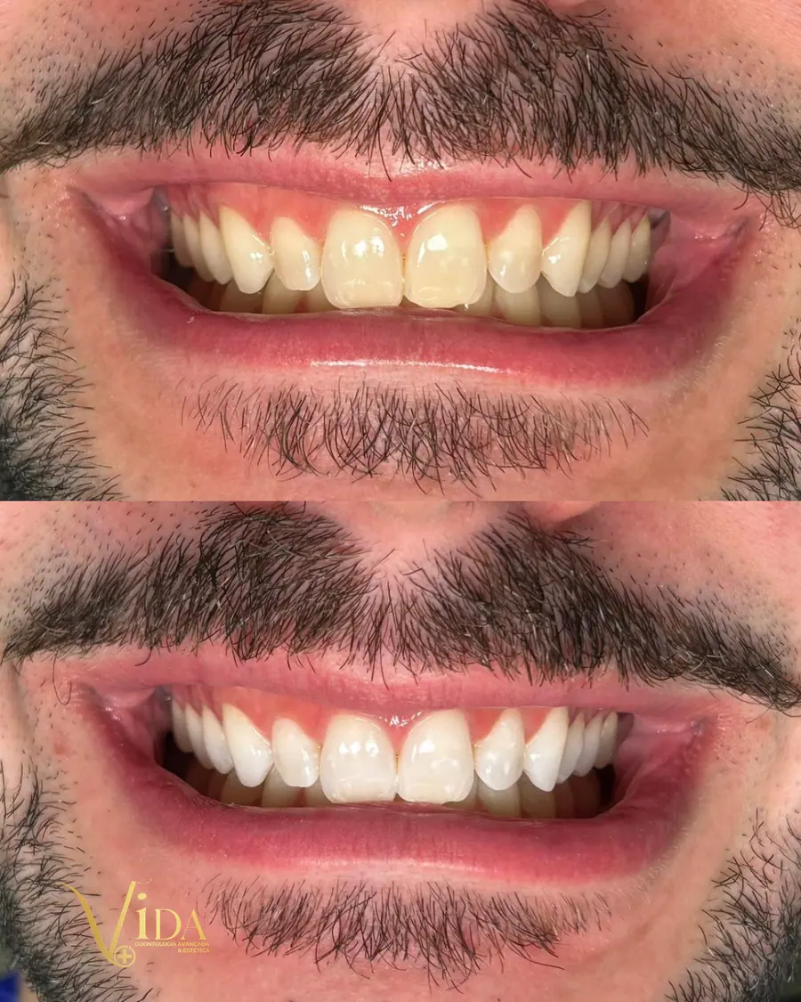 Clareamento dental - caso 1