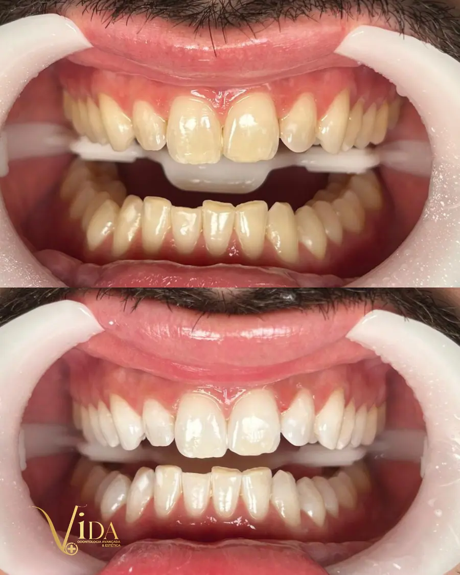 Clareamento dental - caso 2