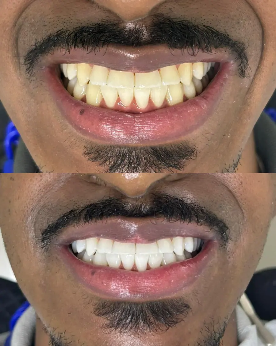 Clareamento dental - caso 3