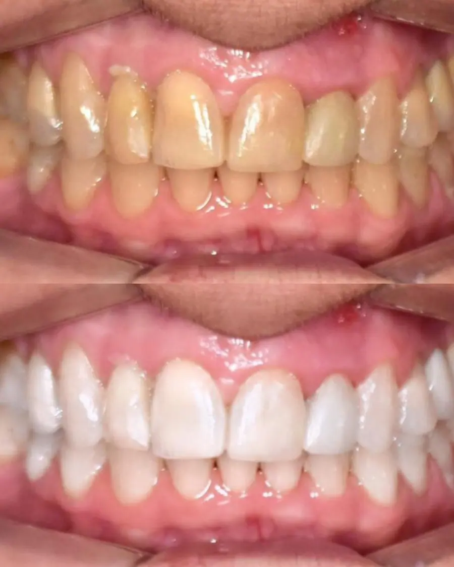 Clareamento dental - caso 4