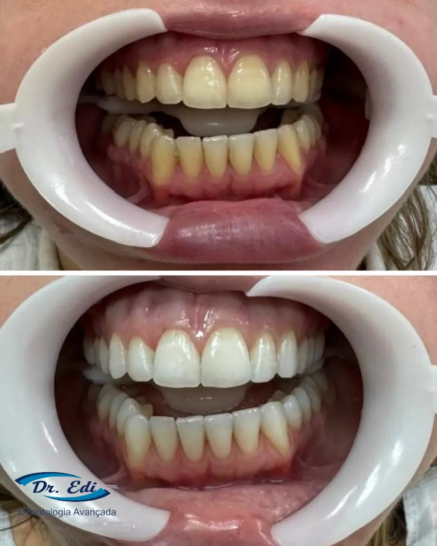 Clareamento dental - caso 5