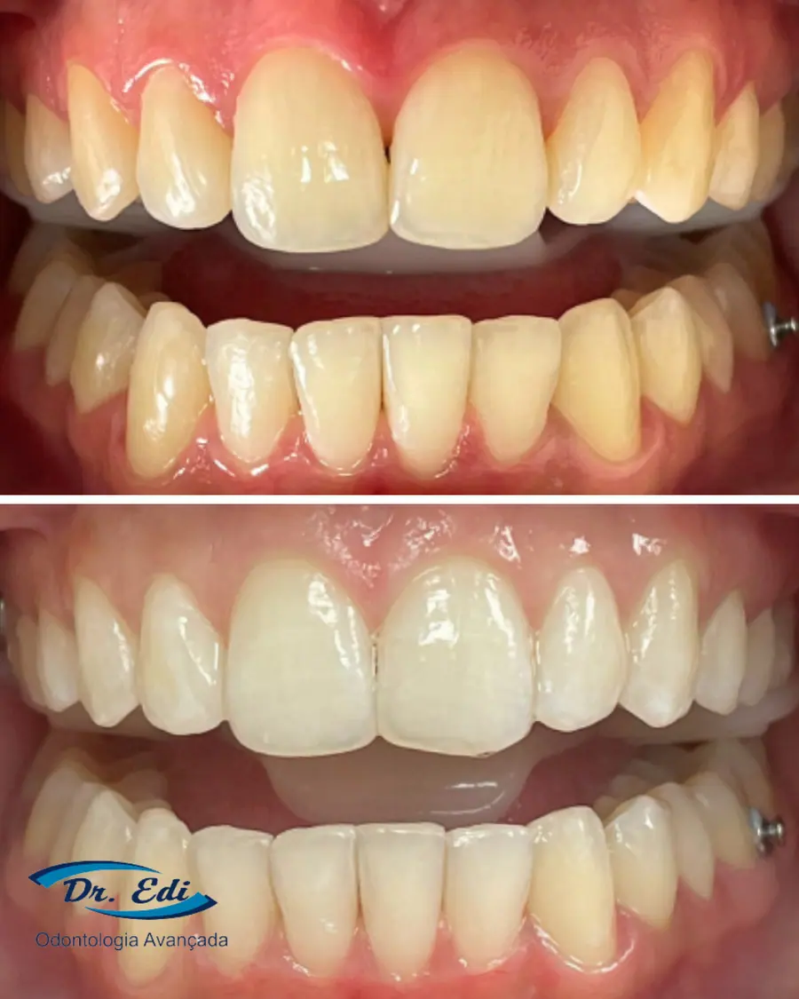 Clareamento dental - caso 6