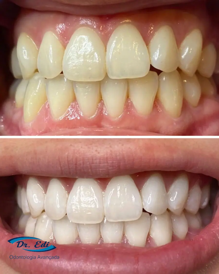 Clareamento dental - caso 7