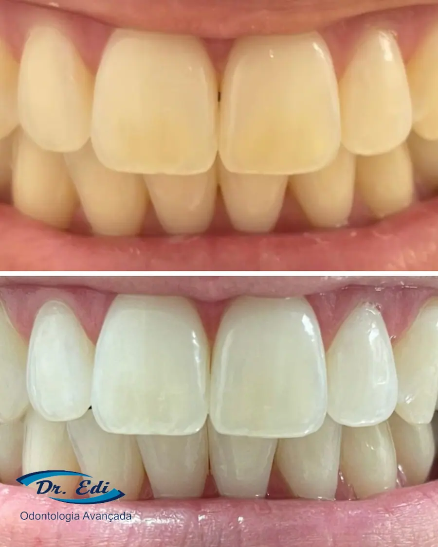 Clareamento dental - caso 8