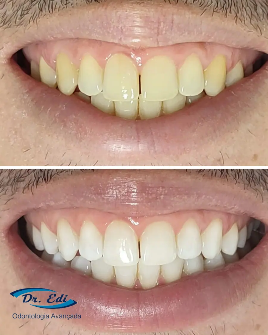 Clareamento dental - caso 9