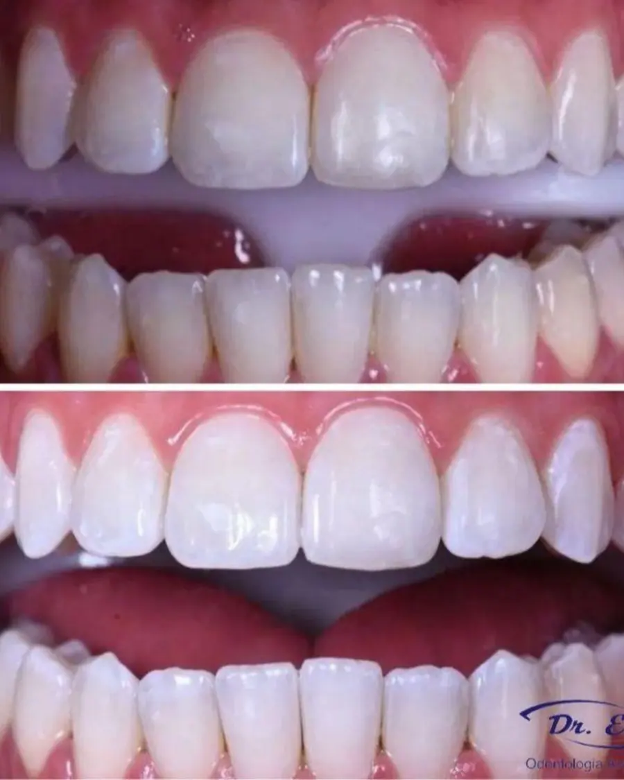 Clareamento dental - caso 10