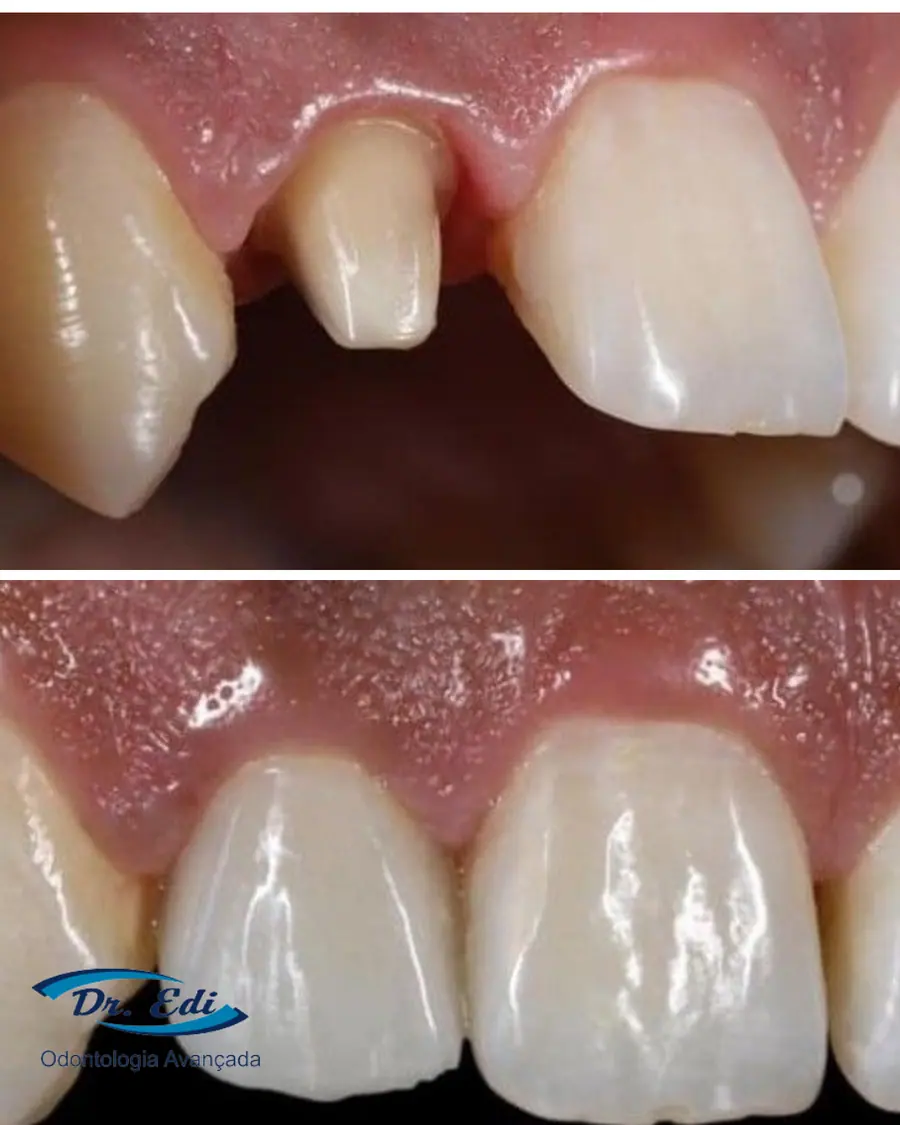 Coroa sobre dente - caso 1