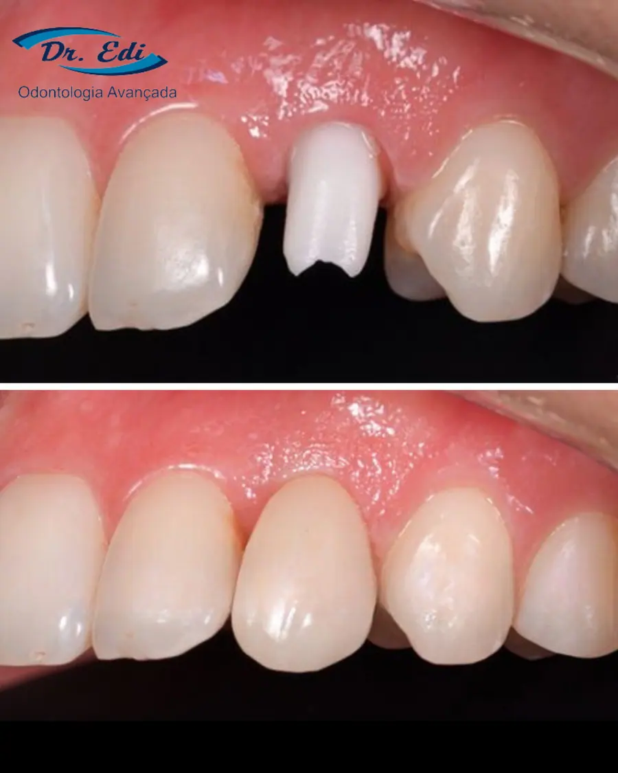 Coroa sobre dente - caso 2