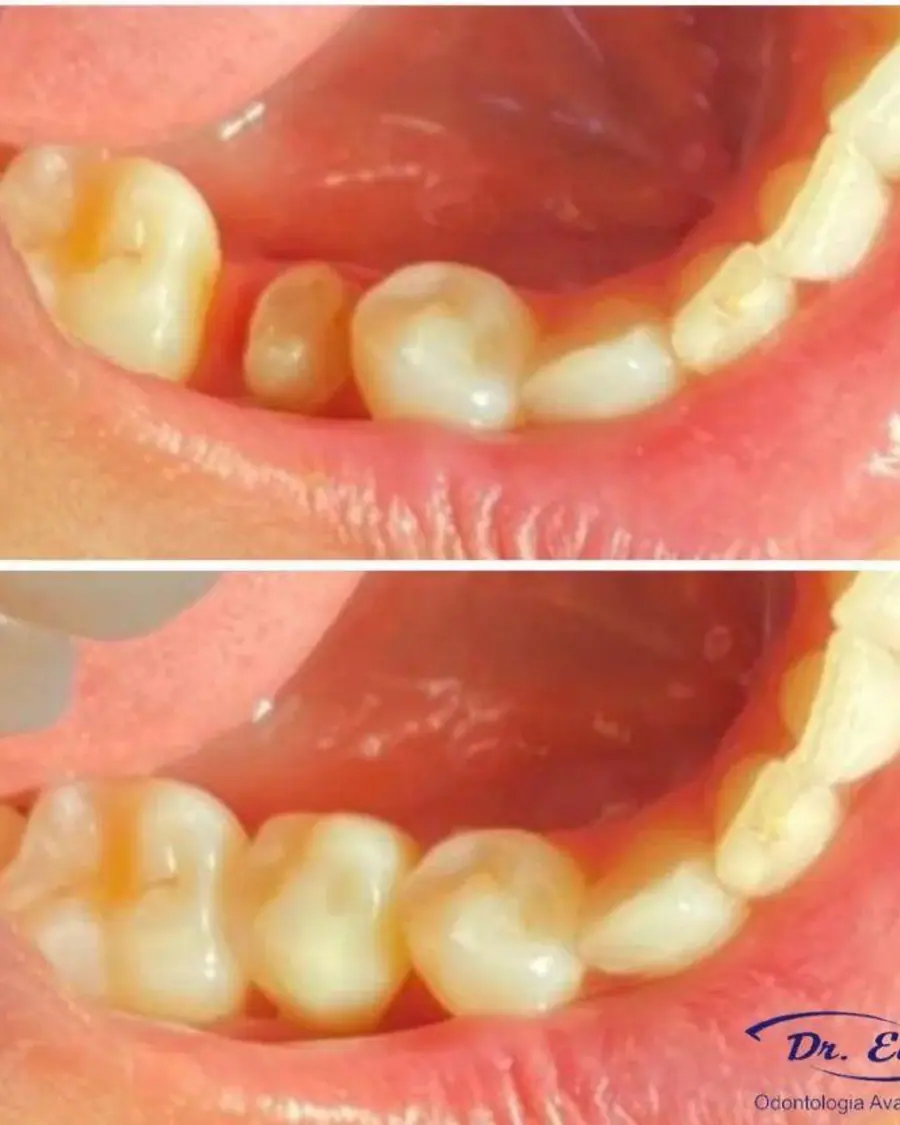 Coroa sobre dente - caso 3