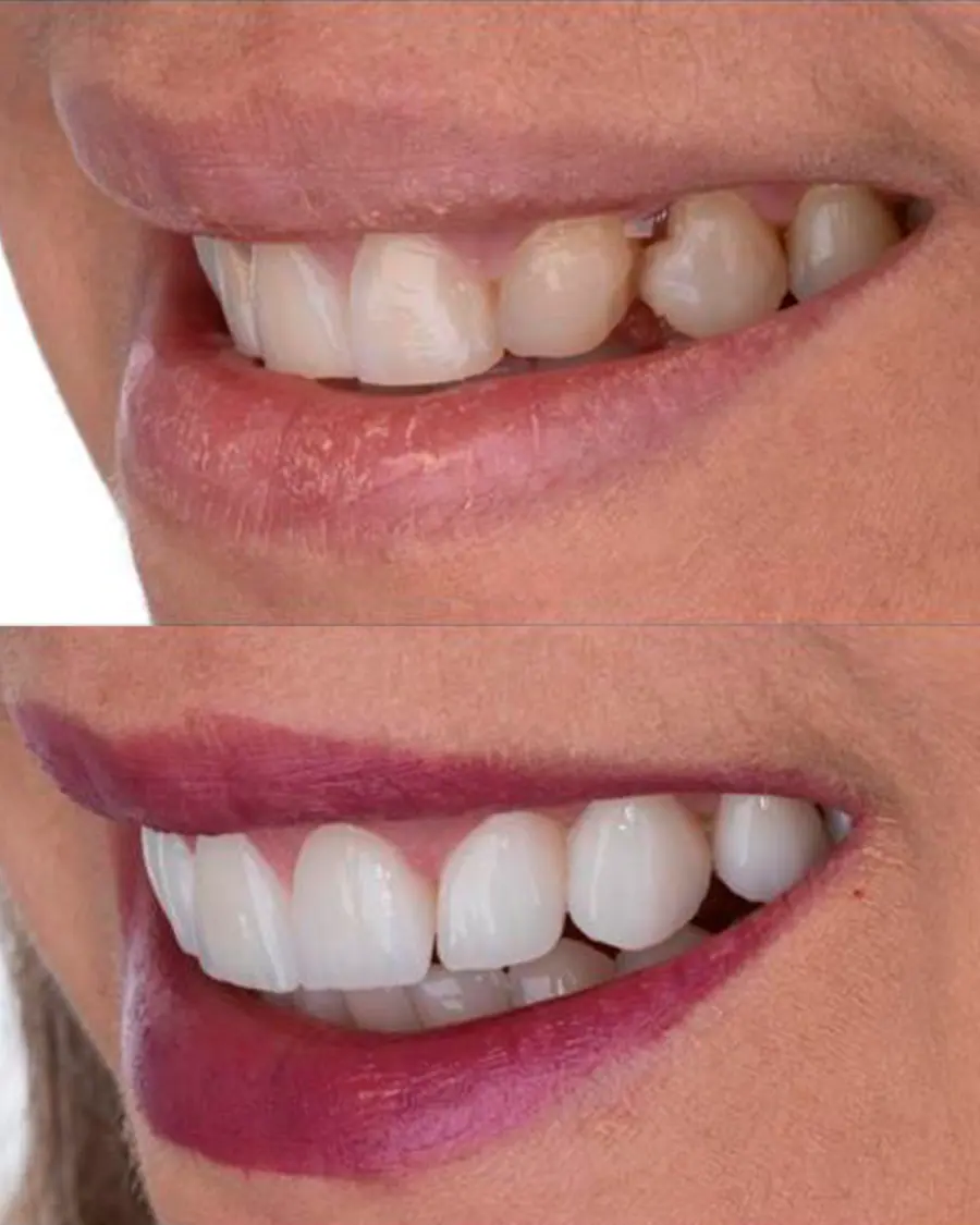 Facetas em porcelana - caso 1