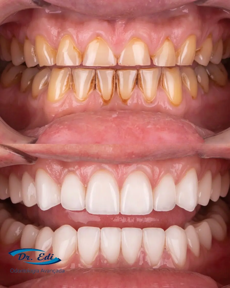 Facetas em porcelana - caso 2