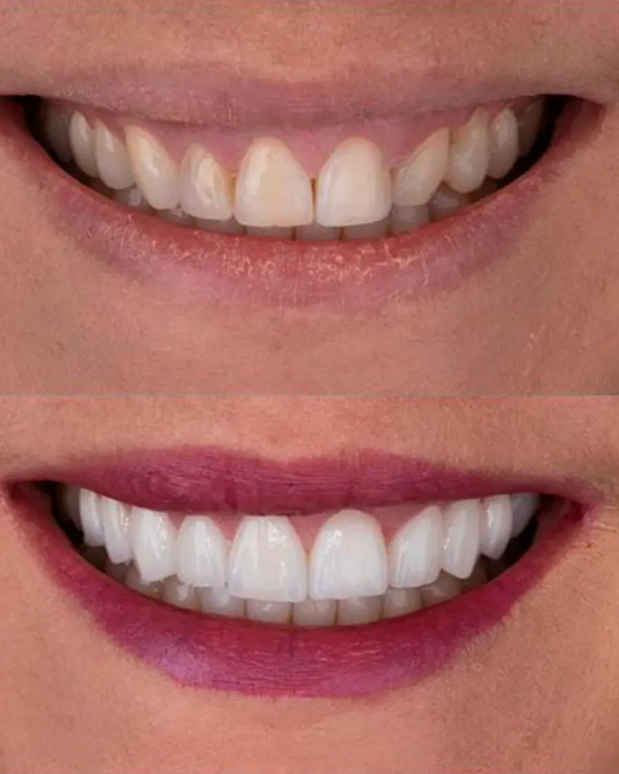 Facetas em porcelana - caso 3