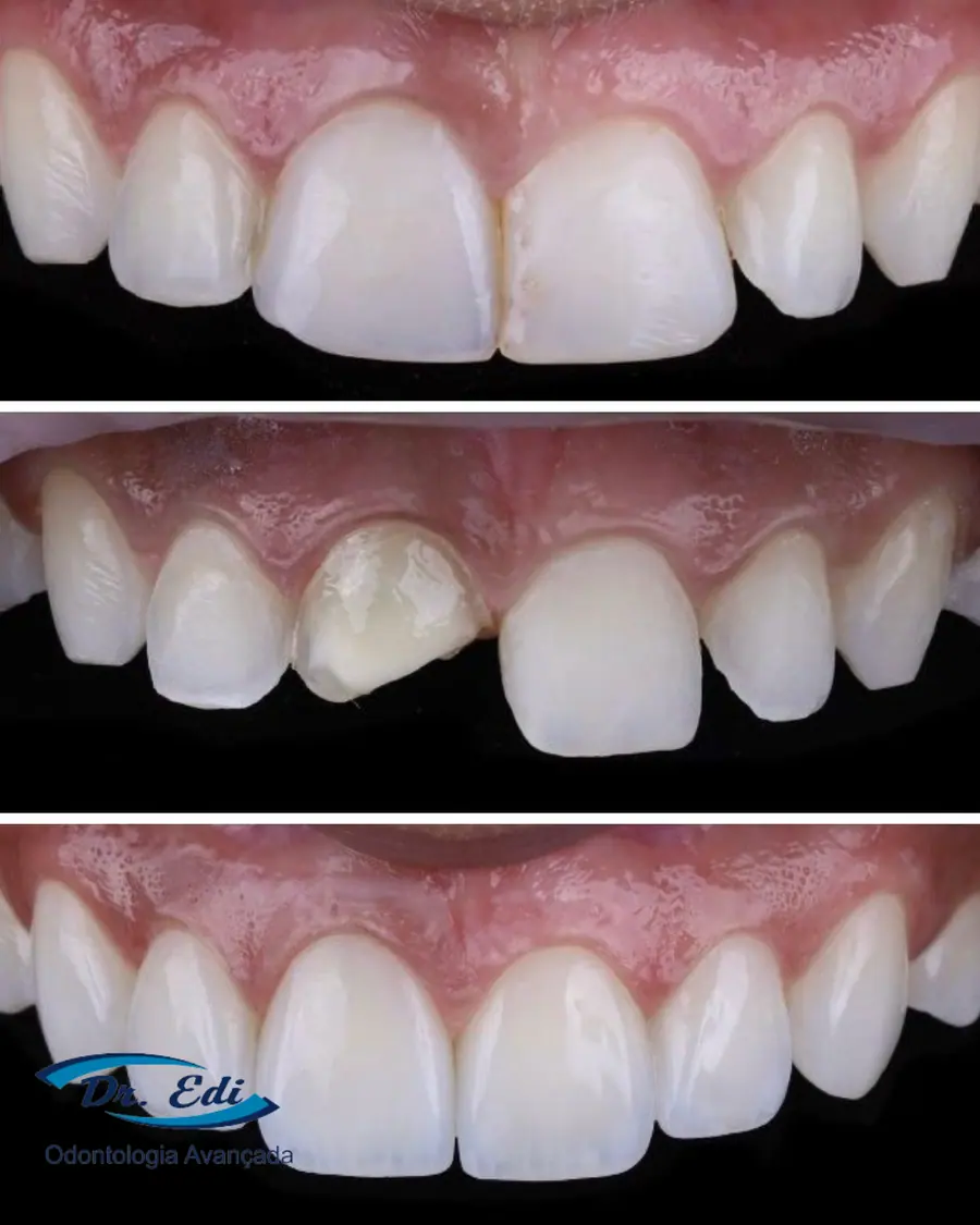 Facetas em porcelana - caso 4
