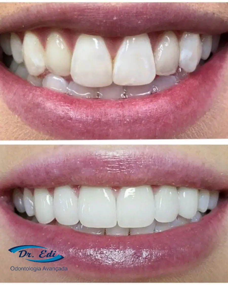 Facetas em porcelana - caso 5