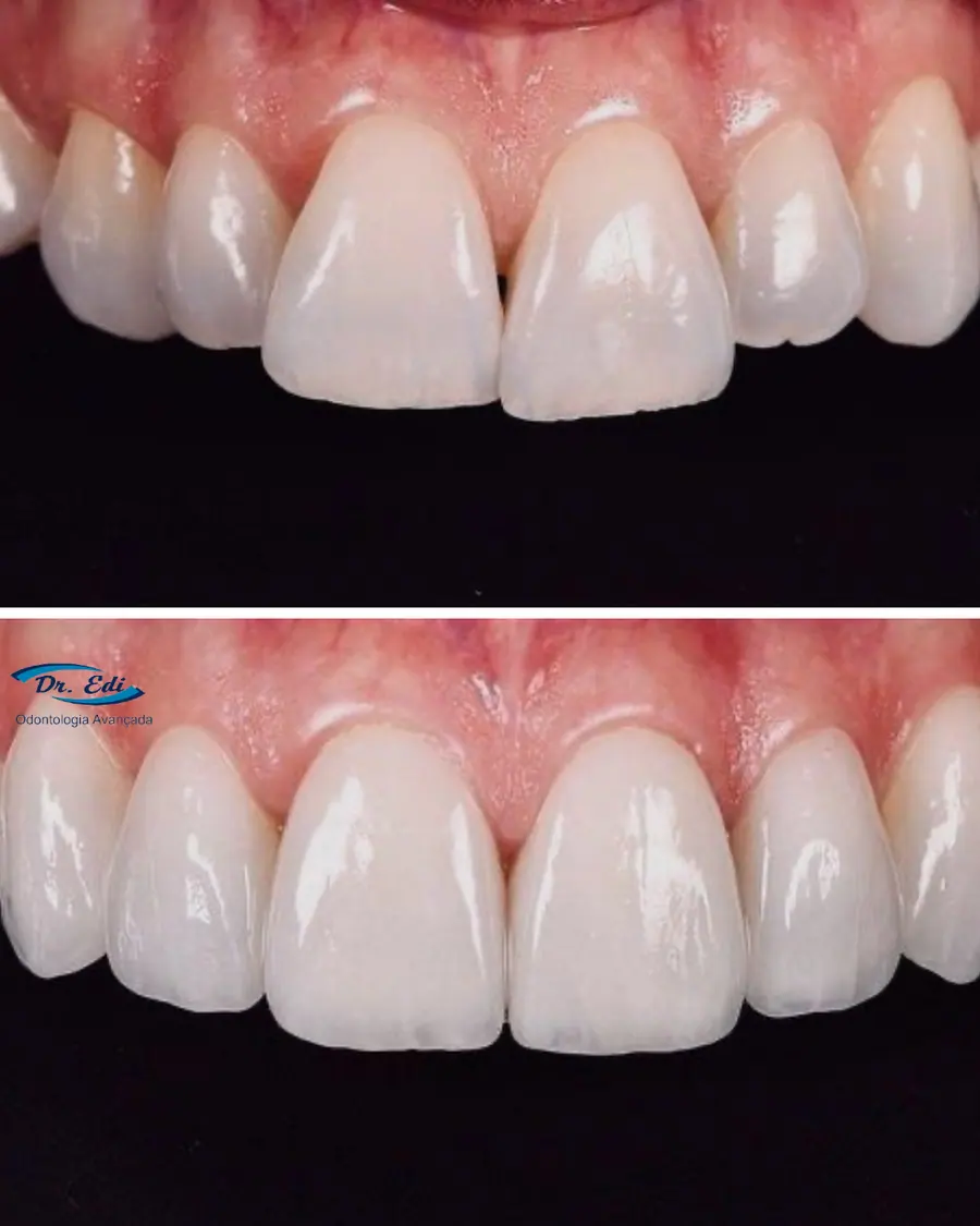 Facetas em porcelana - caso 6