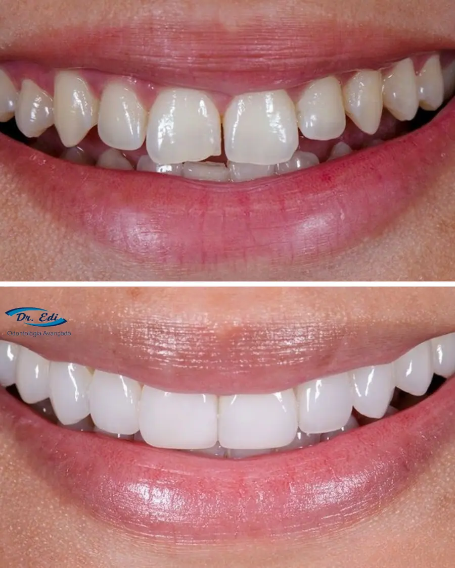Facetas em porcelana - caso 7