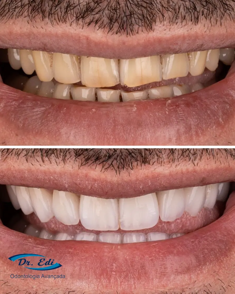 Facetas em porcelana - caso 8