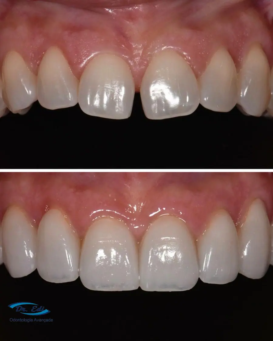 Facetas em porcelana - caso 9