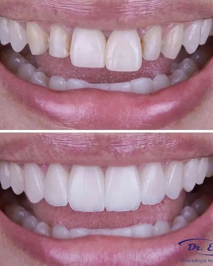 Facetas em resina - caso 2