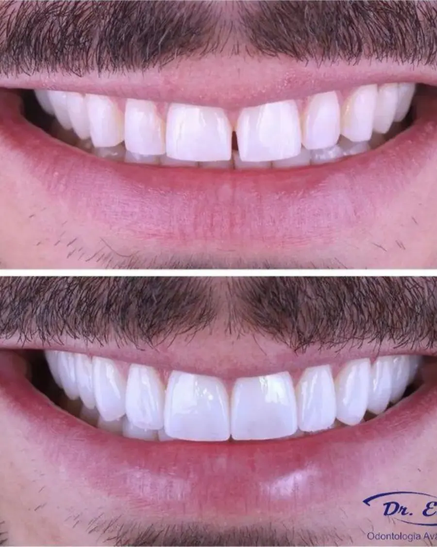 Facetas em resina - caso 3