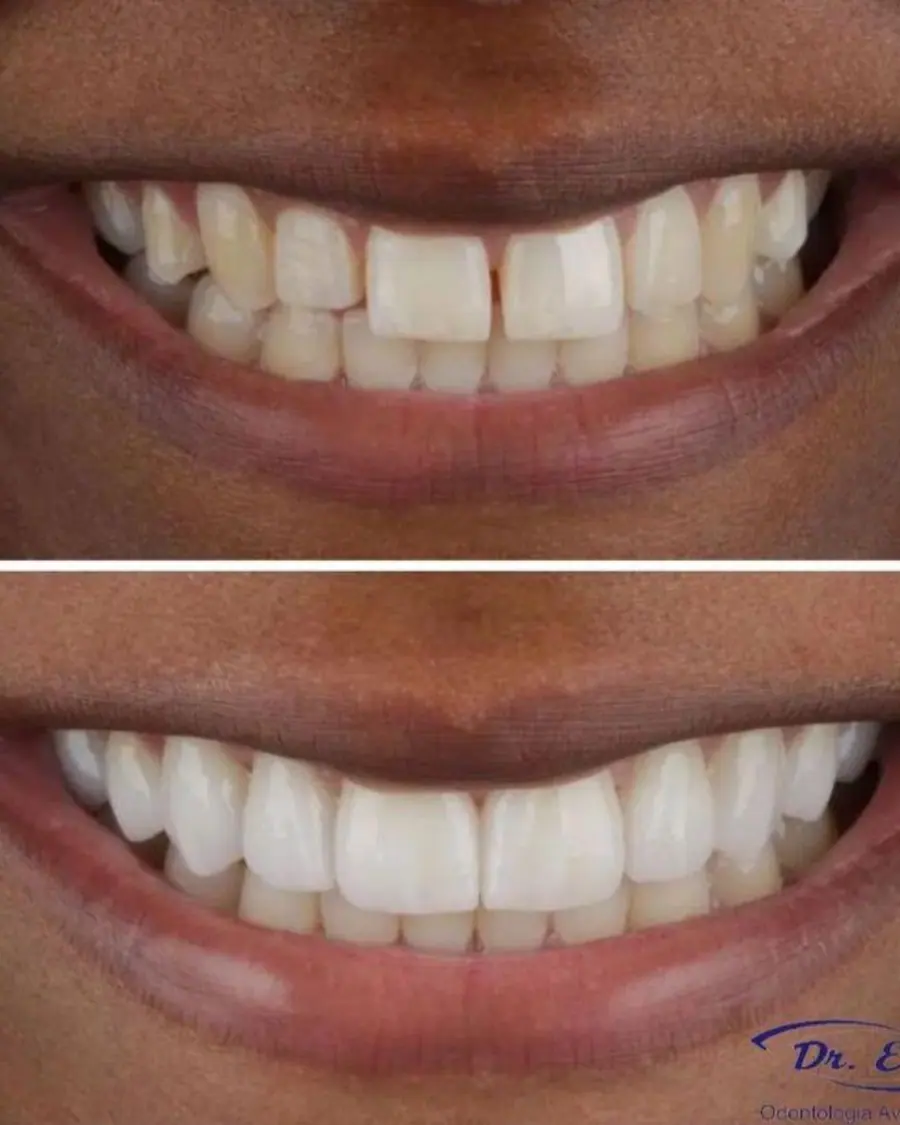 Facetas em resina - caso 4