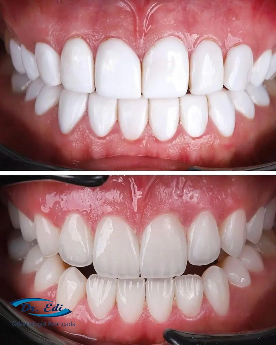 Facetas em resina - caso 5
