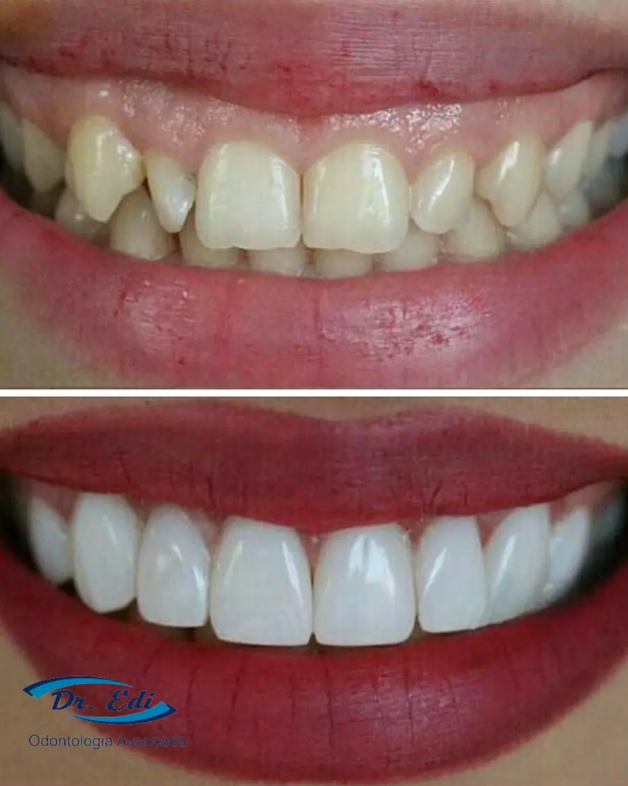 Facetas em resina - caso 6