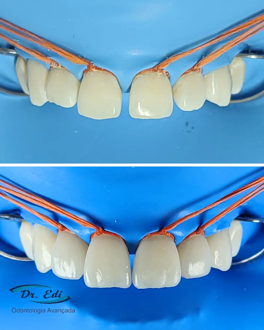 Facetas em resina - caso 8