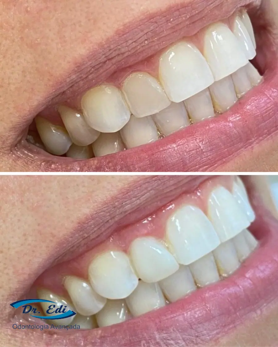 Facetas em resina - caso 9