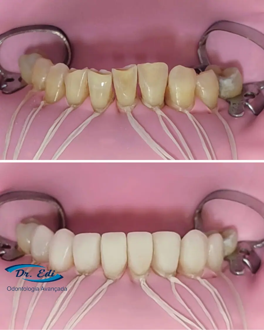 Facetas em resina - caso 10