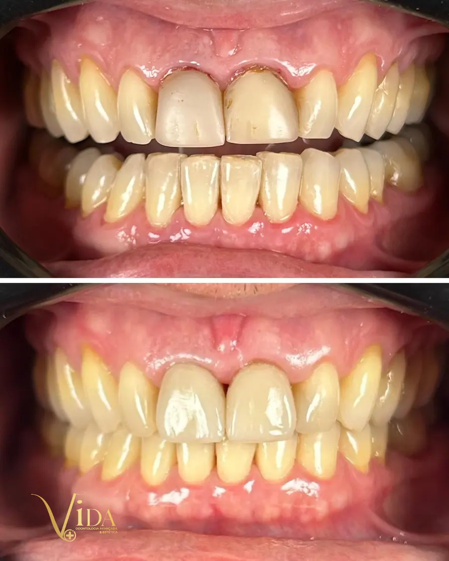 Facetas em resina - caso 12
