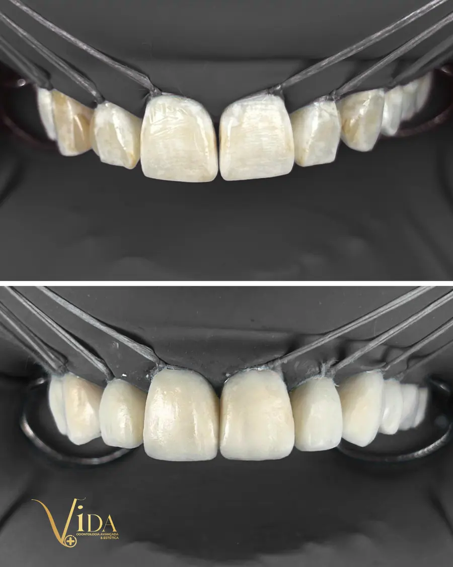 Facetas em resina - caso 17