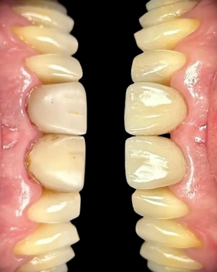 Facetas em resina - caso 18