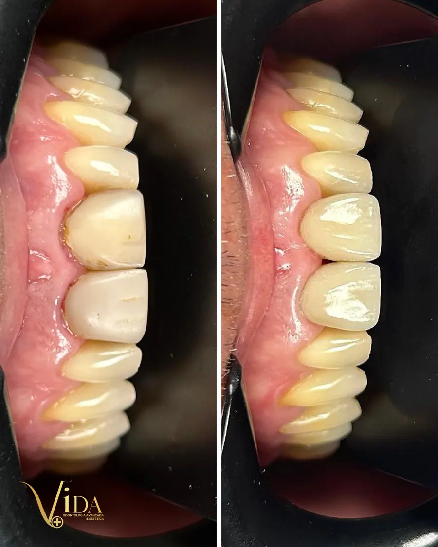 Facetas em resina - caso 21