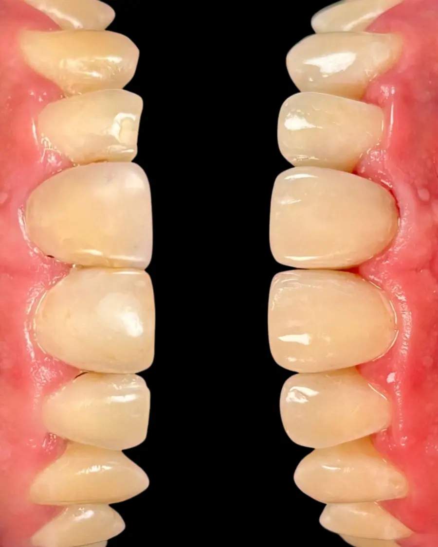 Facetas em resina - caso 22