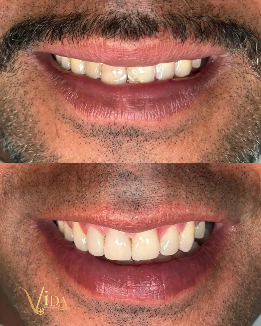 Facetas em resina - caso 24