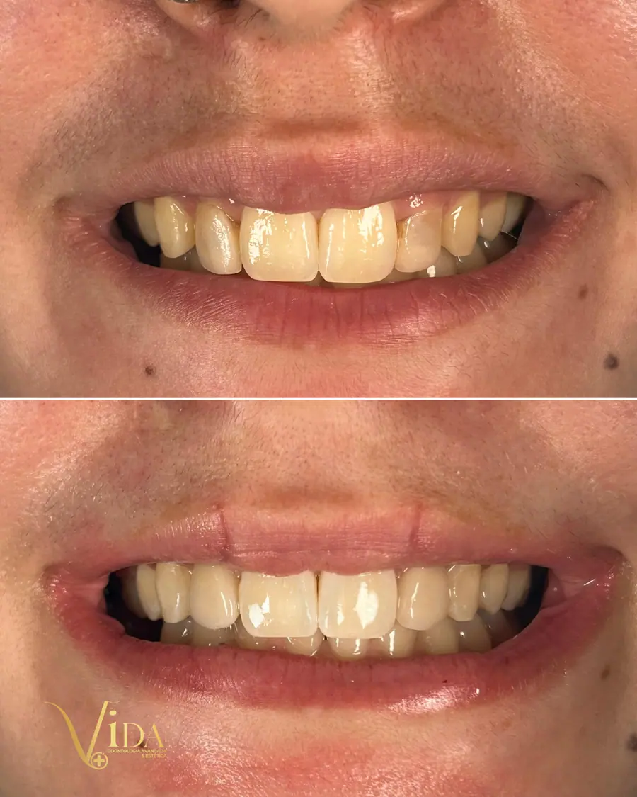 Facetas em resina - caso 27