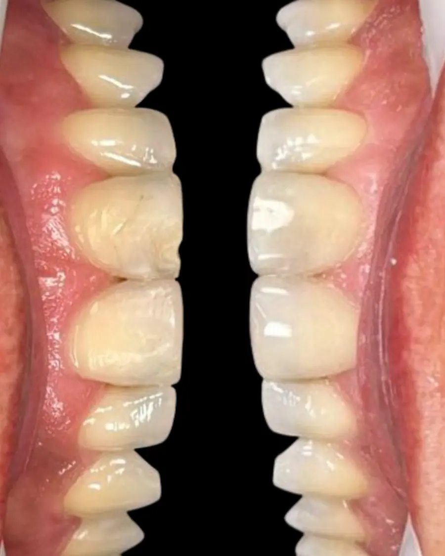 Facetas em resina - caso 28