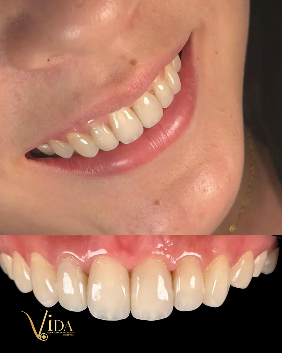 Facetas em resina - caso 30