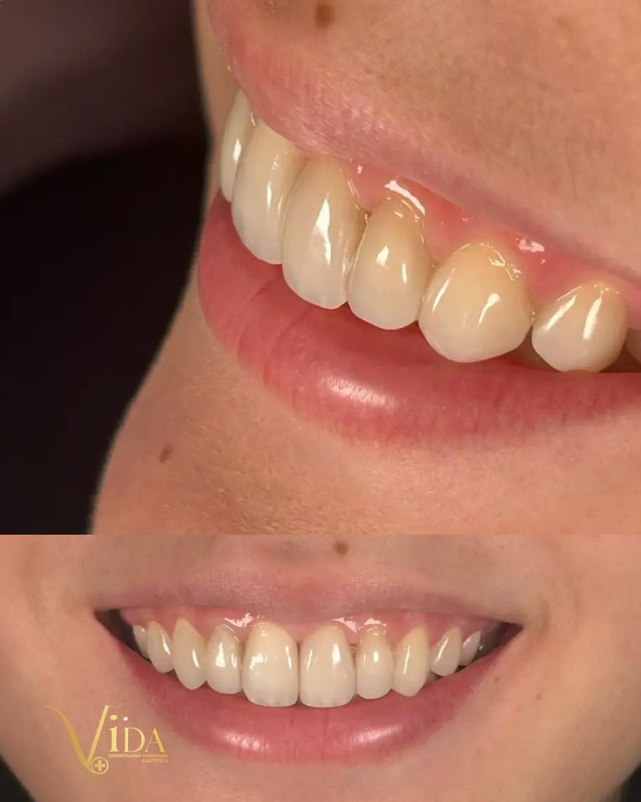 Facetas em resina - caso 31