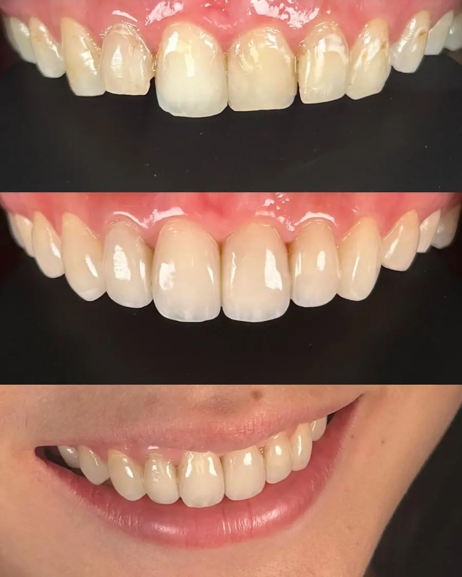 Facetas em resina - caso 32