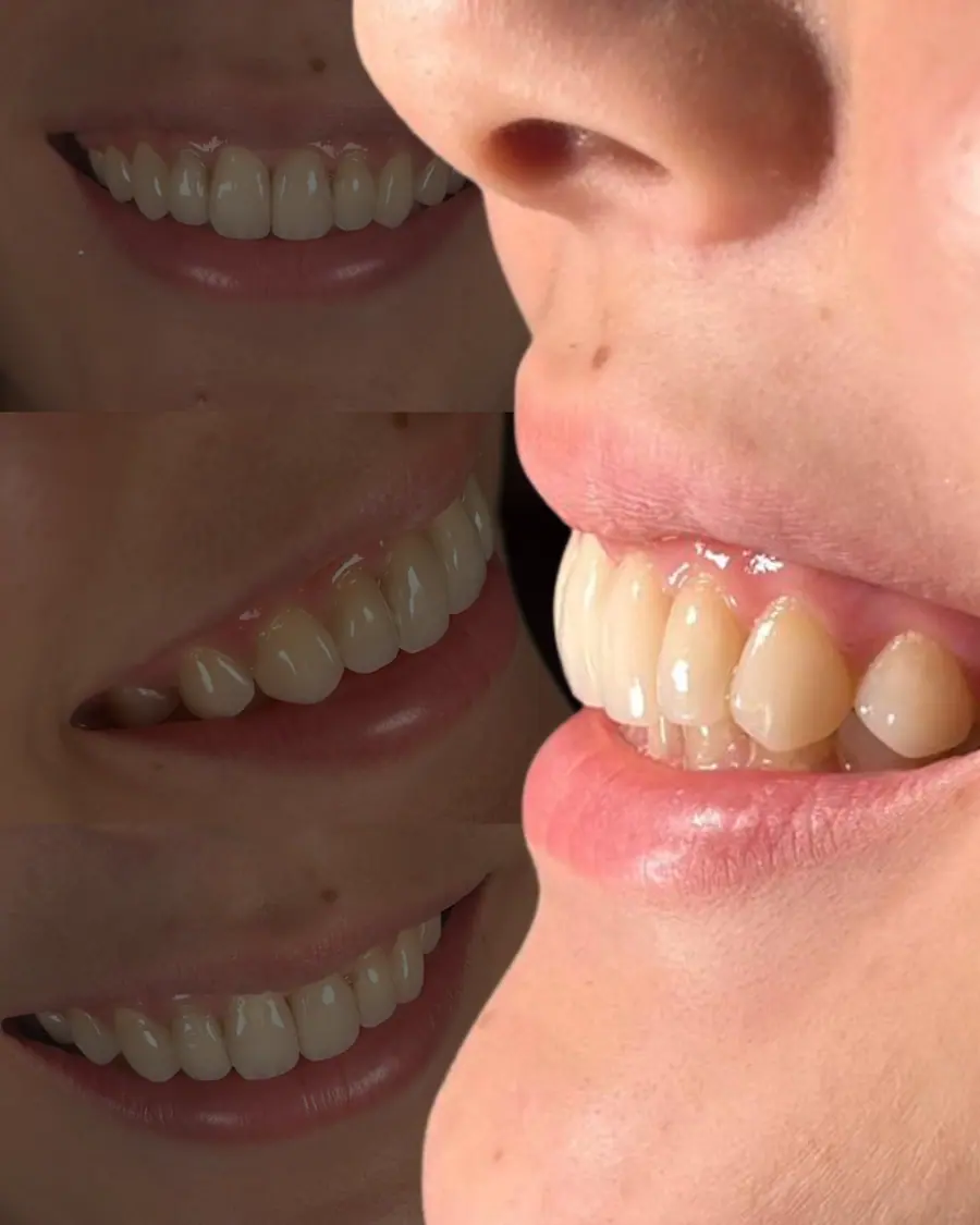 Facetas em resina - caso 33